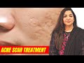 How to treat acne scars  acne scar treatment by dr aisha ghias acne acnescars