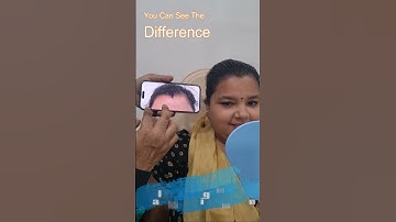 SCALP MICROPIGMENTATION