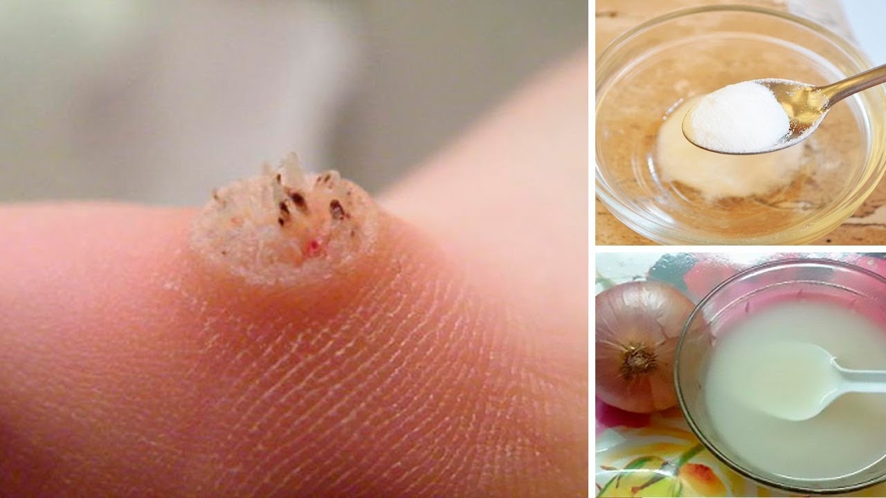 How To Get Rid Of Warts Naturally