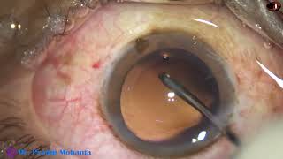 Management of a soft cataract - Grade 2 NS -  using prechopper : Dr Pradip Mohanta, 19 Jan, 2022 screenshot 4