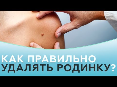 Родинки. Методы удаления родинок. Как удалить родинку