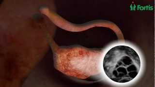 IVF, Fertility Treatment, Assisted Conception, pregnancy, Test Tube Baby