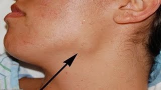 Download Lagu Reactive lymph nodes/Bangla Health Education/Dr.Joydeb Singha Download Lagu Reactive lymph nodes/Bangla Health Education/Dr.Joydeb Singha