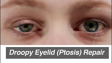 Wie bekommt man Ptosis?