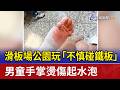 滑板場公園玩「不慎碰鐵板」 男童手掌燙傷起水泡