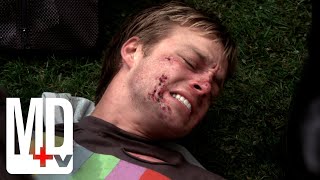 Halloween Hooligan Gets Chemical Burn from own Prank | Trauma | MD TV