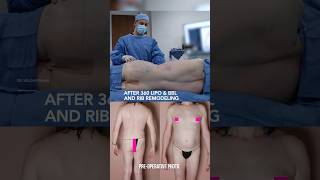 Gender Affirming Surgery - 360 Lipo & Bbl With Rib Remodeling Before & After Results