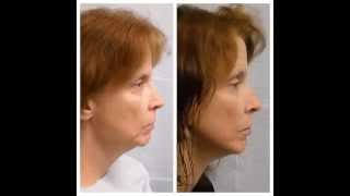 Brazillian Butt Lift | Tampa Lipo |