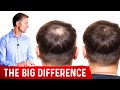 Normal Hair Loss vs. Abnormal Hair Loss