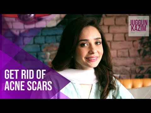 How to Get Rid of Acne Scars | Remove Marks on Your Skin | Juggun Kazim | Beauty Hacks