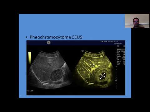 Imaging of the adrenal gland