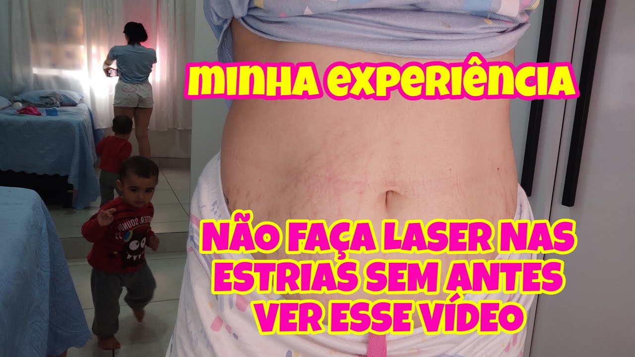 Tratamento Caseiro Para Estrias Pós Parto - RETOEDU