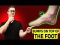 Bumps on Top of the Foot? (Best Top of FOOT PAIN Treatment)[2021]