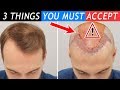 3 Things You Must Accept before Your Hair Transplant!!!