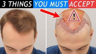 3 Things You Must Accept before Your Hair Transplant!!! 3 Things Before You Get A Hair Transplant