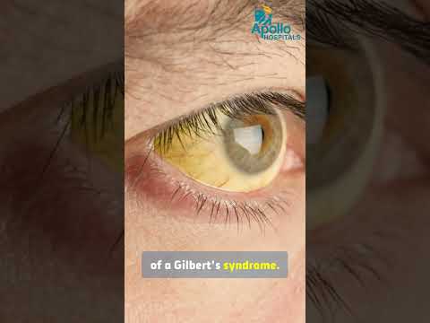 نظرة عامة على متلازمة جيلبرت