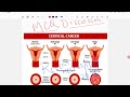 Mutiple choice questions (MCQ) Cancer cervix and endometrial cancer discussion/recent/neet pg2024-25