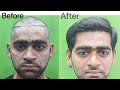 Best hair transplant results 6 months  fue vs dhi vs sapphire fue vs big fue hair transplant cost