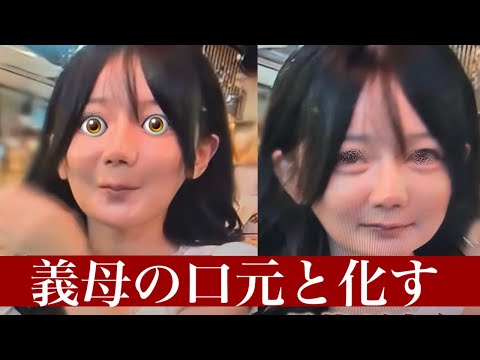 【悲報】フェフ姉さんの多田さん、コリアで輪郭2点の顎骨切り（両顎手術）を行った結果、義母みたいな下顔面が完成する
