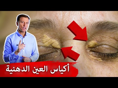 أكياس وبقع حول العين أسبابها وعلاجها!