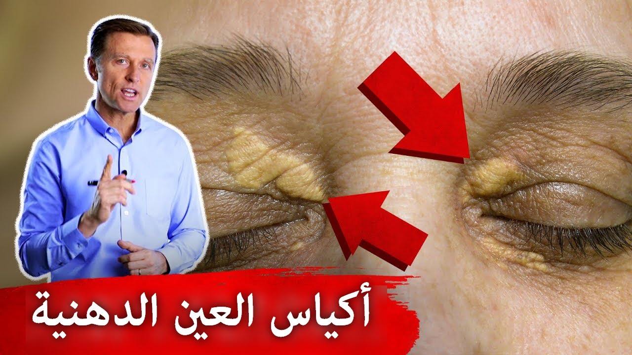 أكياس وبقع حول العين أسبابها وعلاجها!