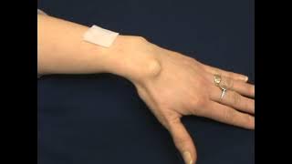 wrist ganglion aspiration