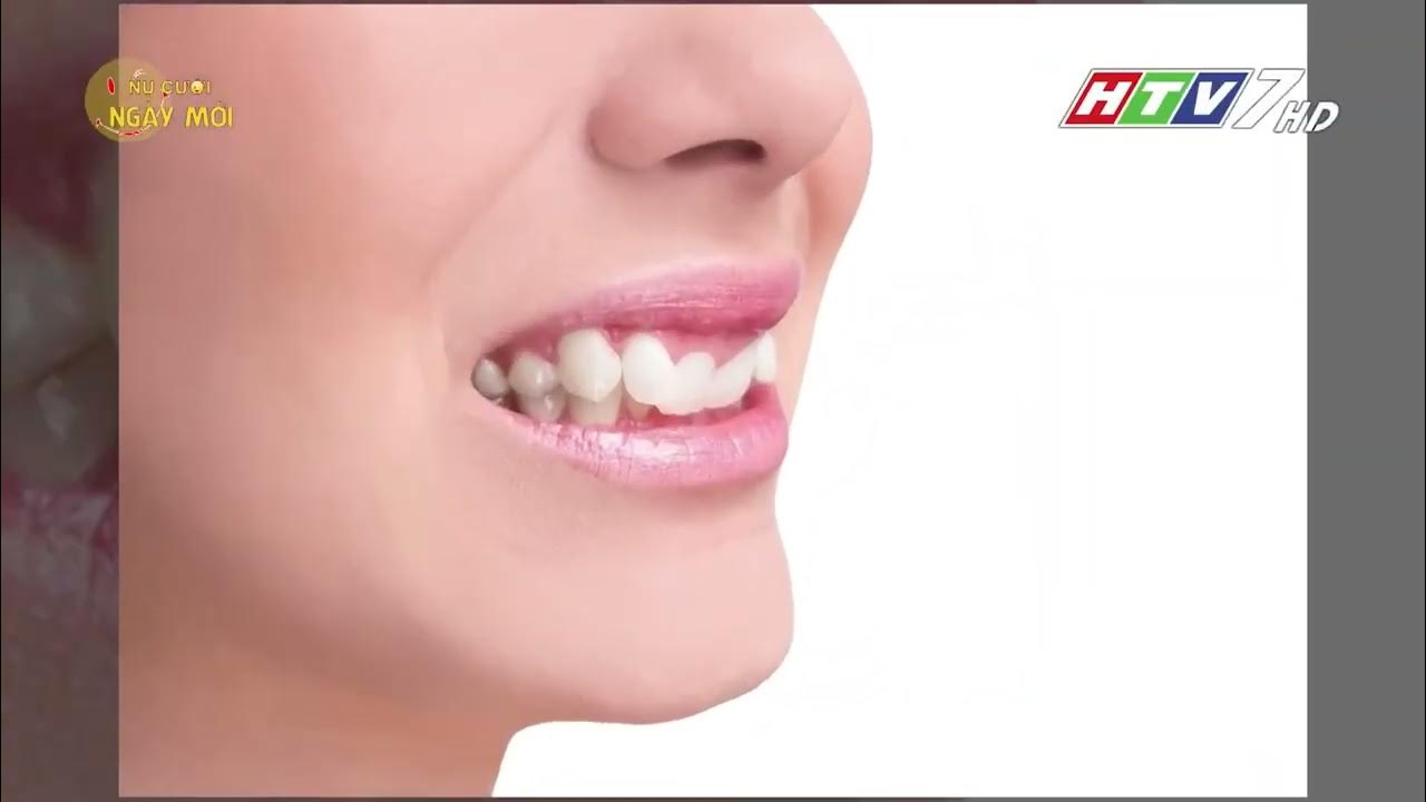 UCARE DENTAL TÌM HIỂU VỀ BỆNH TỤT NƯỚU RĂNG YouTube