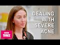 Dealing With Severe Acne: Skin