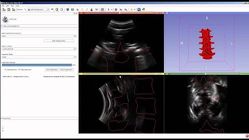 Statistical Shape Model registered to lumbar spine in 3D Slicer