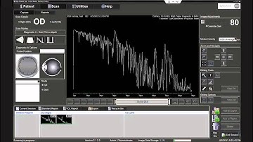 Performing Diagnostic A-Scan with the Ellex Eye Cubed
