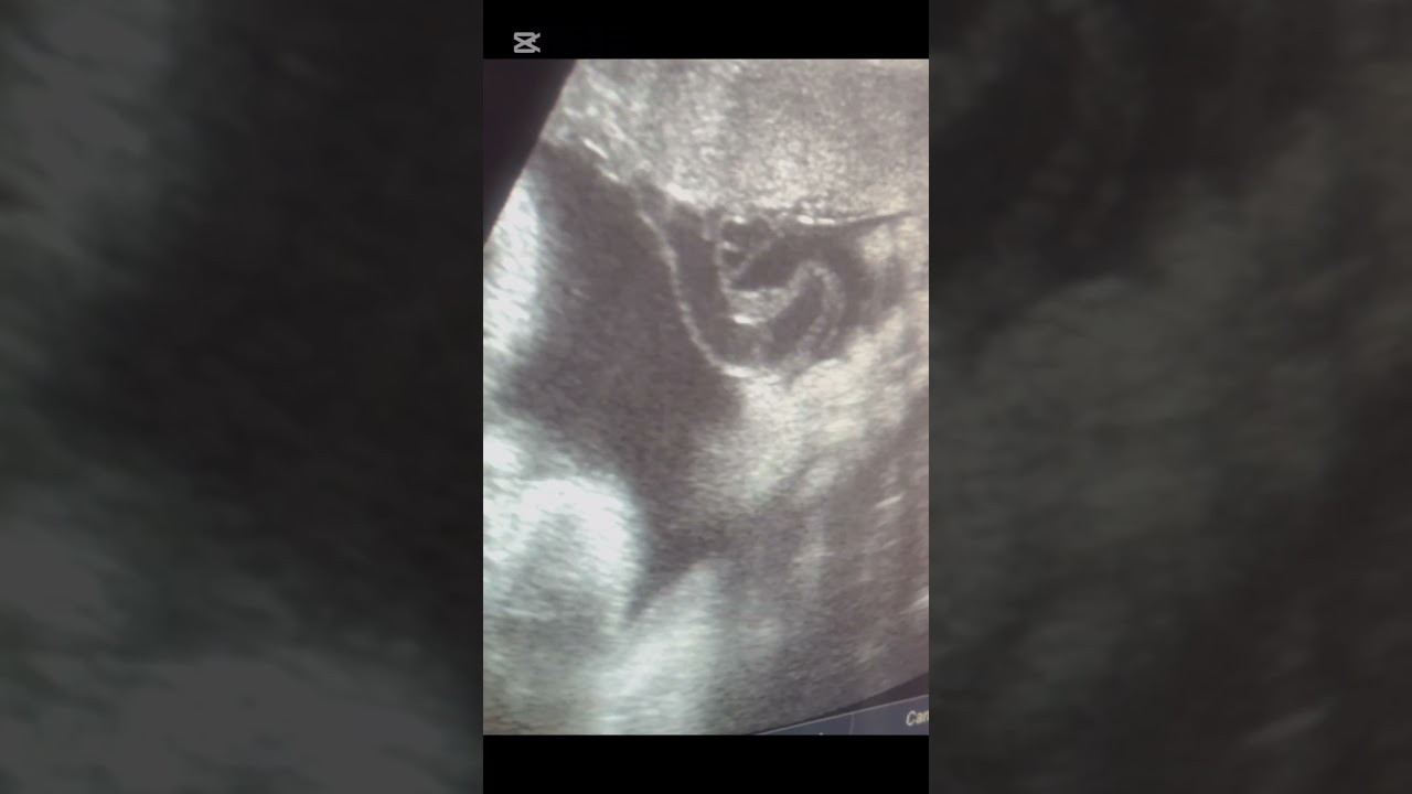 Cordocentesis transplacentarea.  