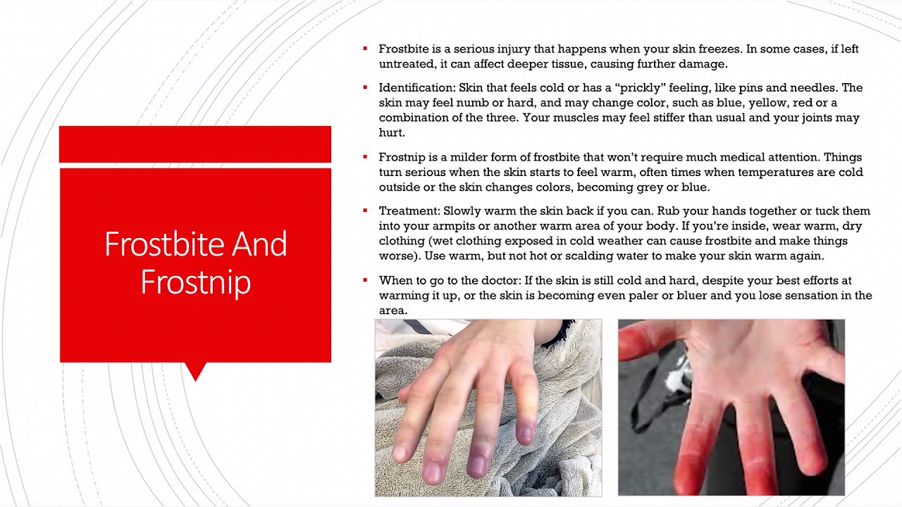 First Aid 17 Frost nip And Frostbite YouTube