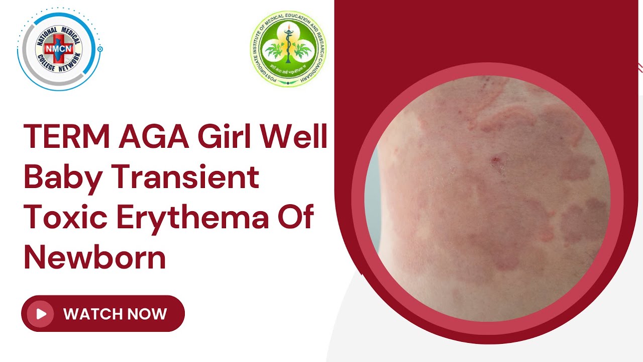 TERM AGA Girl Well Baby Transient Toxic Erythema Of Newborn YouTube