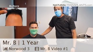Fort Lauderdale Hair Transplant Clinic | Permanent Hair Restoration Video After 1 Year Results
