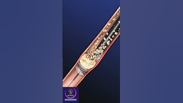 Thumbnail of Removal of kidney stones through shockwave #shorts