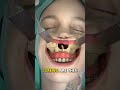 Why This Jaw Surgery Will Change Your Face Forever