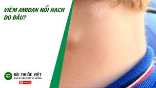 Viêm Amidan NỔI HẠCH Ở CỔ có N.G.UY HIÊM không? Cần làm gì khi mắc phải? | BÀI THUỐC VIỆT