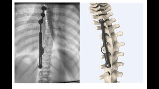 Posterior Dynamic Distraction Device for #Scoliosis