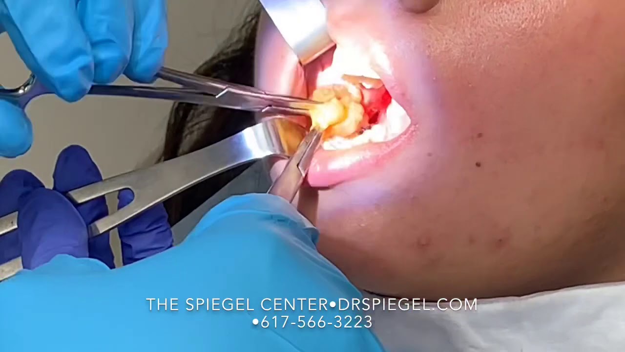 Buccal Fat Extraction YouTube Buccal Fat Extraction YouTube