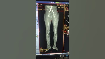 CT Angiography of lower limb