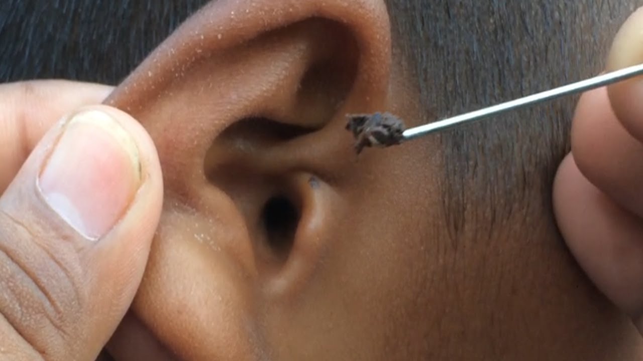 how to remove wax from ear