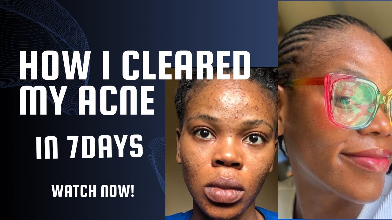 How I cleared my acne in 7 days; A MUST WATCH: #acnefree #skincare # ...