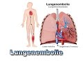 Lungenembolie - Krankheiten der Blutgefäße