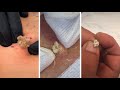 Huge pimple popping cyst removal  blackhead removal  cyst  blackheads  acne treatment  asmr