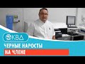 😧 Черные наросты на члене. Клинический случай №944