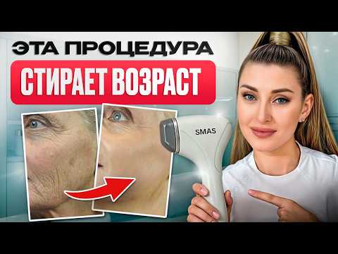 ГЛАДКАЯ и КРАСИВАЯ кожа БЕЗ операции! / Что такое SMAS-лифтинг и кому он точно подойдет?