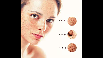 ¿Puede un dermatólogo detectar un melanoma?