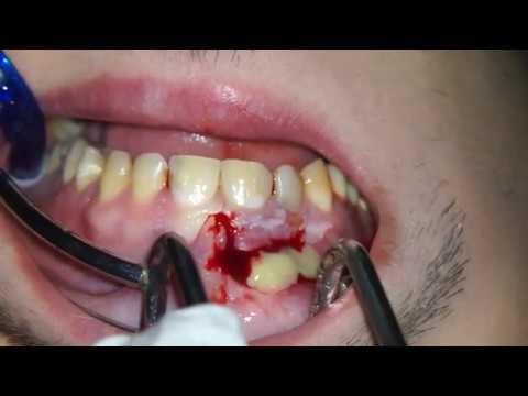 Video PUS ABSCESS INCISION DRAINAGE Endodontic Root Canal... - youtube