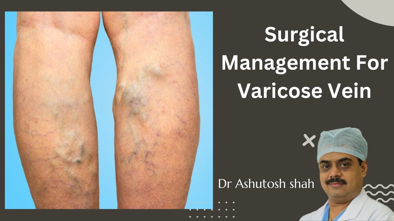 Surgical Management For Varicose Vein, Twisted Vein, Surgery, Kolhapur