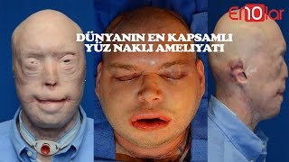 En kapsamlı yüz nakli yapılan patrick'in 10 madde İle ameliyat aşaması